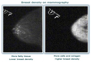 100222_breast-density